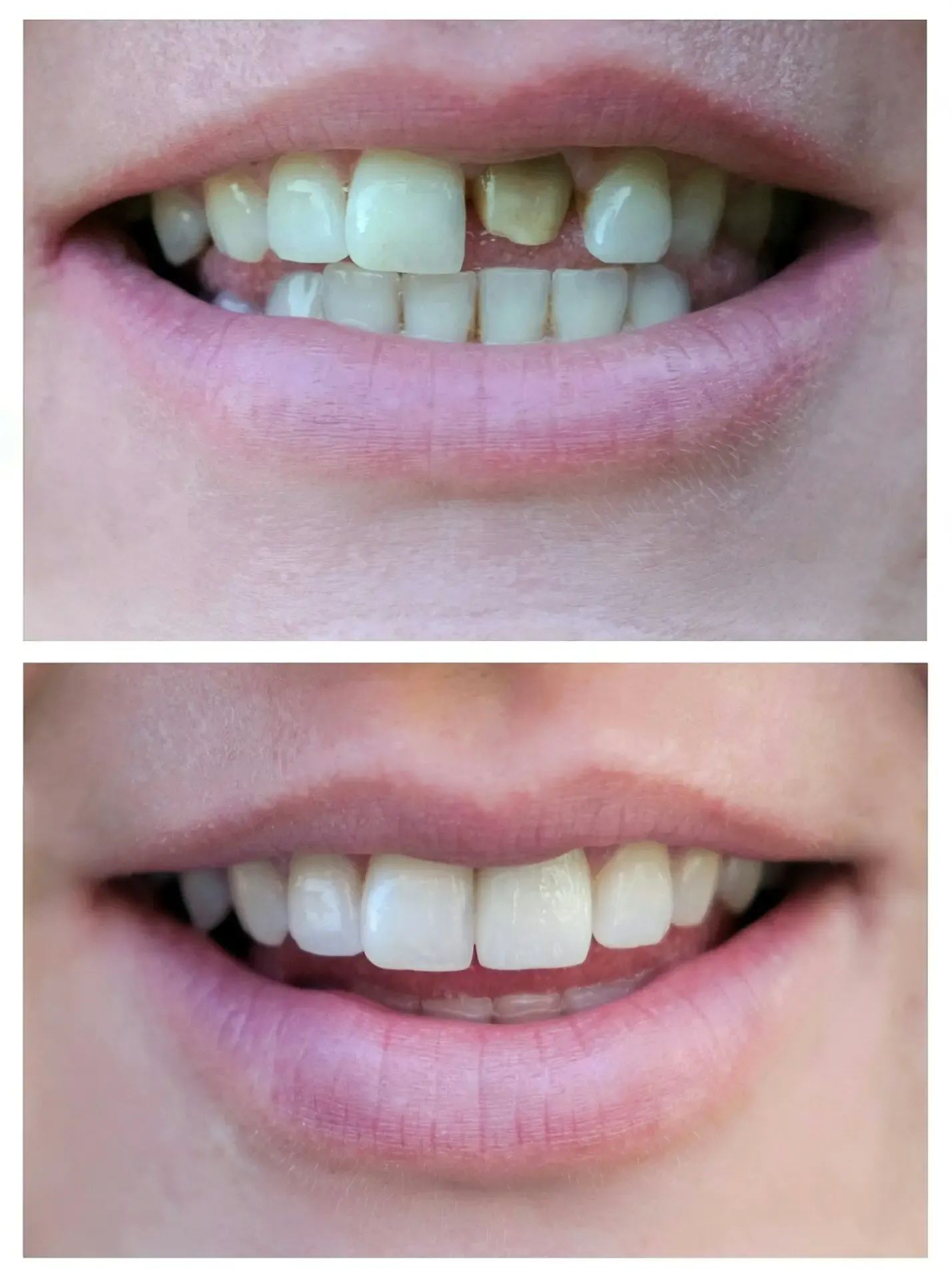 A smiling woman before and after veneer treatment