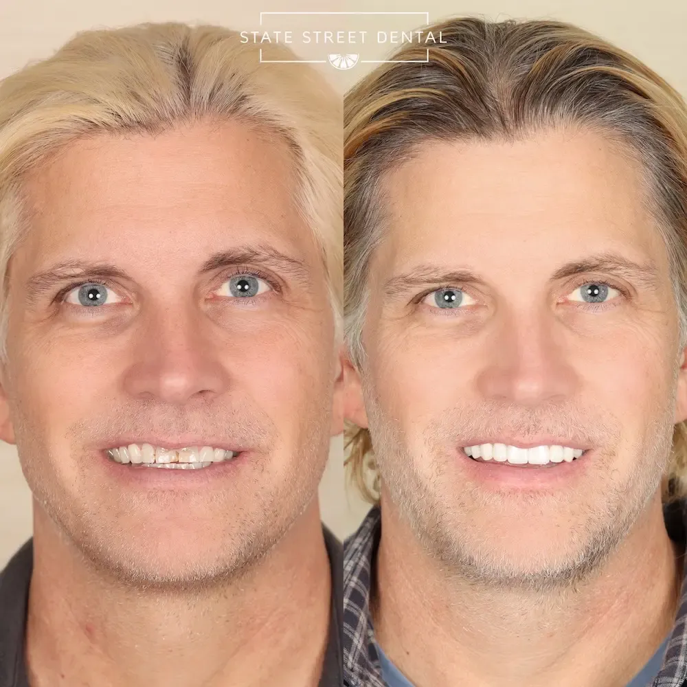 A State Street Dental veneers patient showing off their new smile