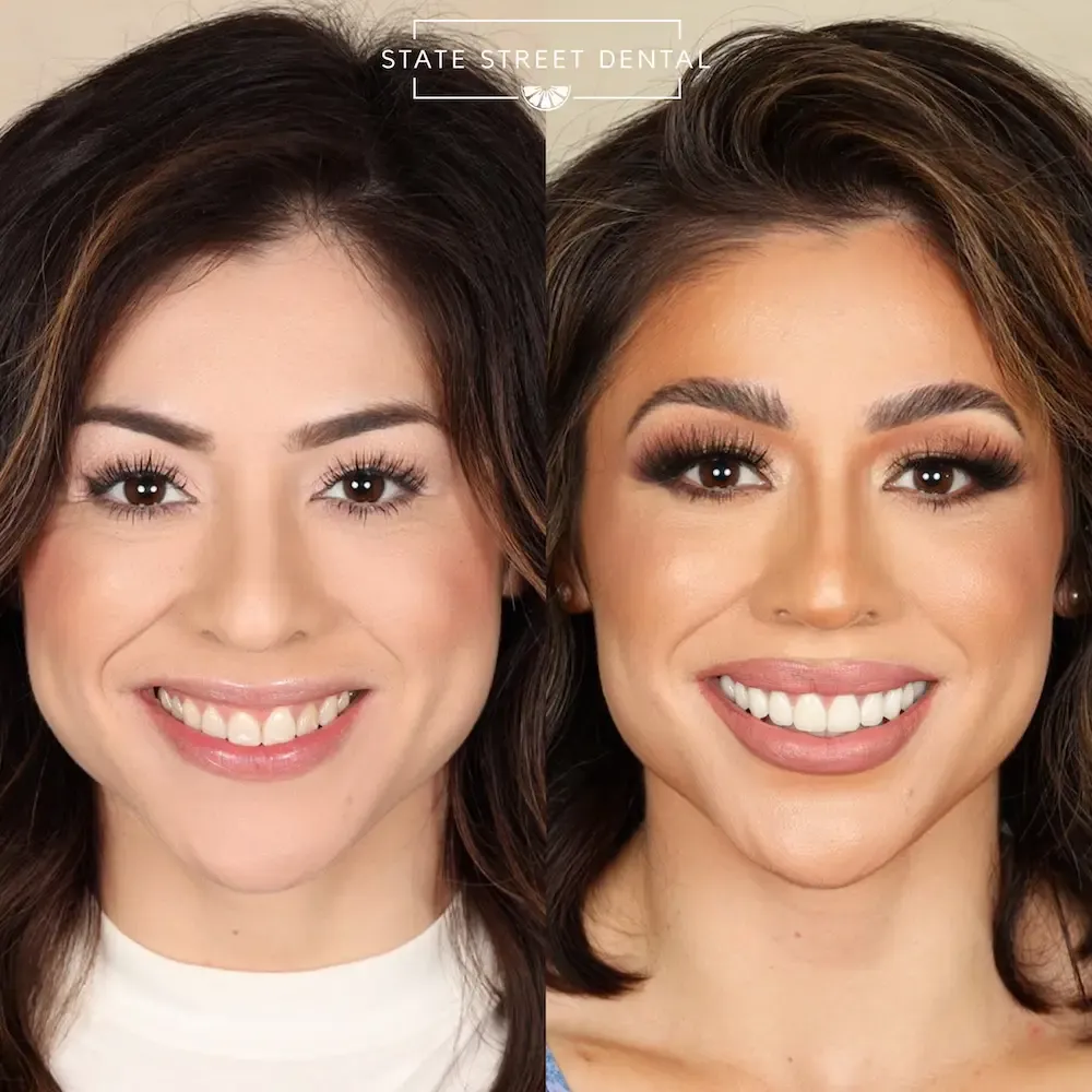 A State Street Dental veneers patient showing off their new smile