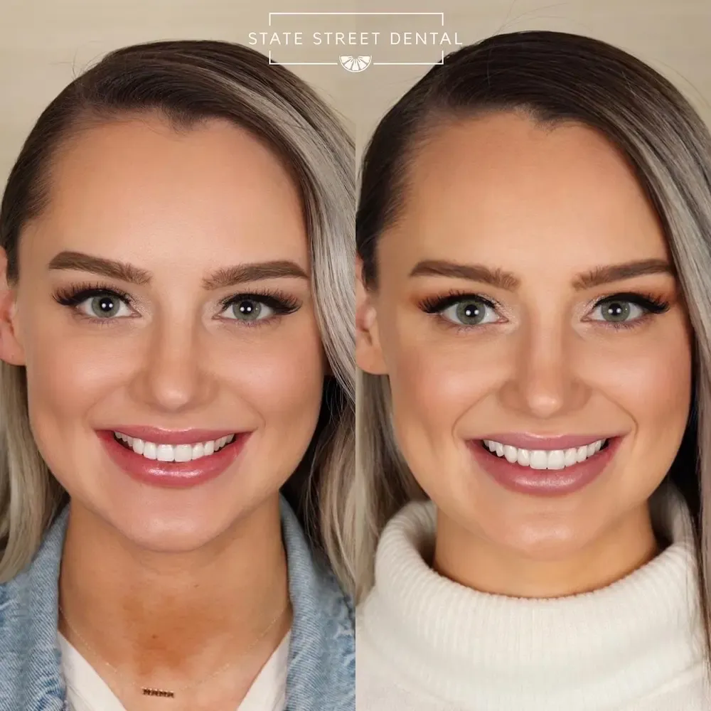 A State Street Dental veneers patient showing off their new smile
