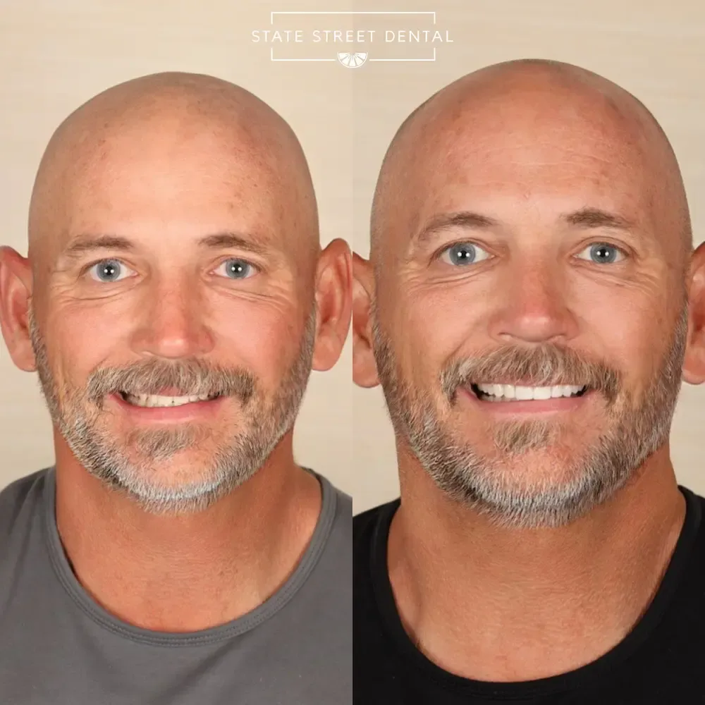 A State Street Dental veneers patient showing off their new smile
