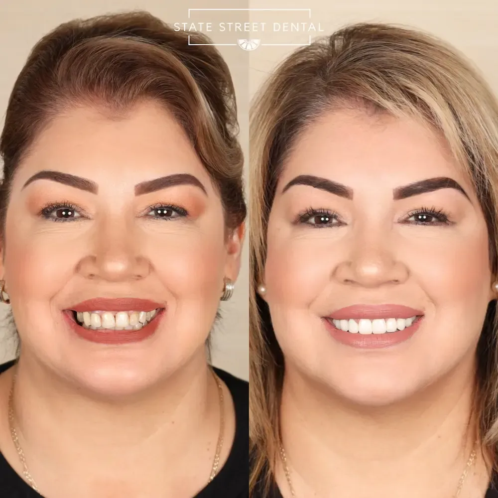 A State Street Dental veneers patient showing off their new smile