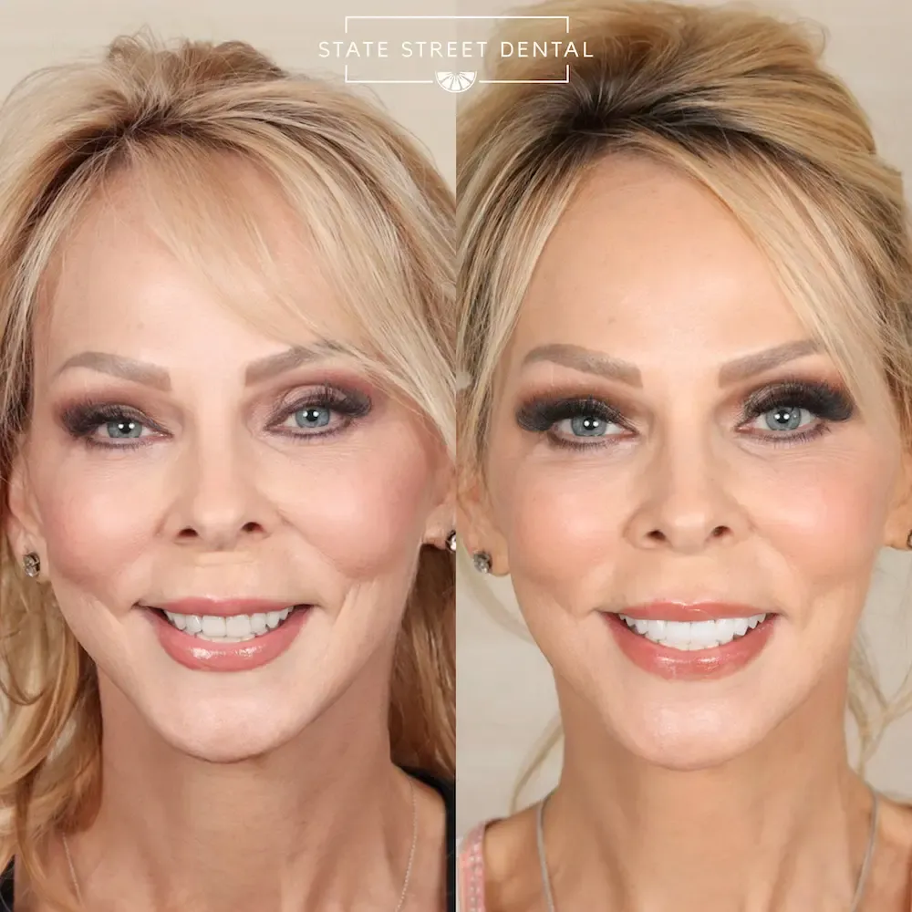 A State Street Dental veneers patient showing off their new smile