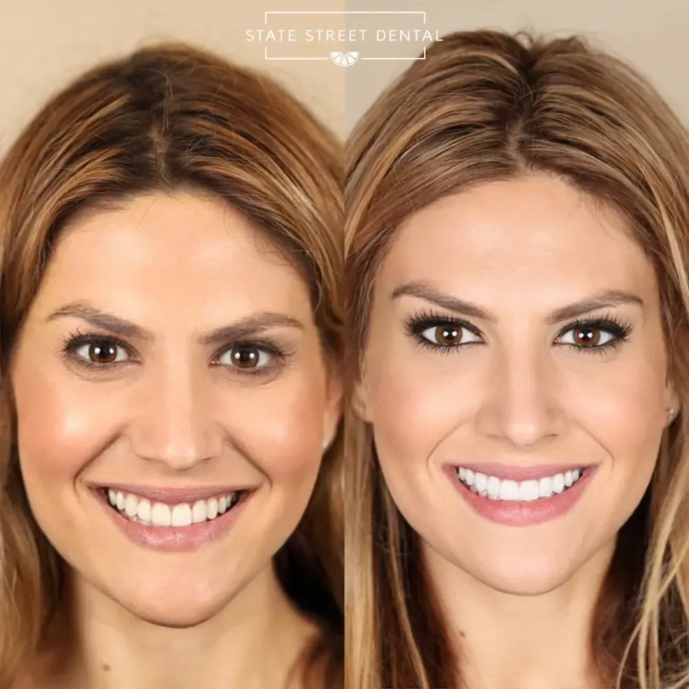 A State Street Dental veneers patient showing off their new smile