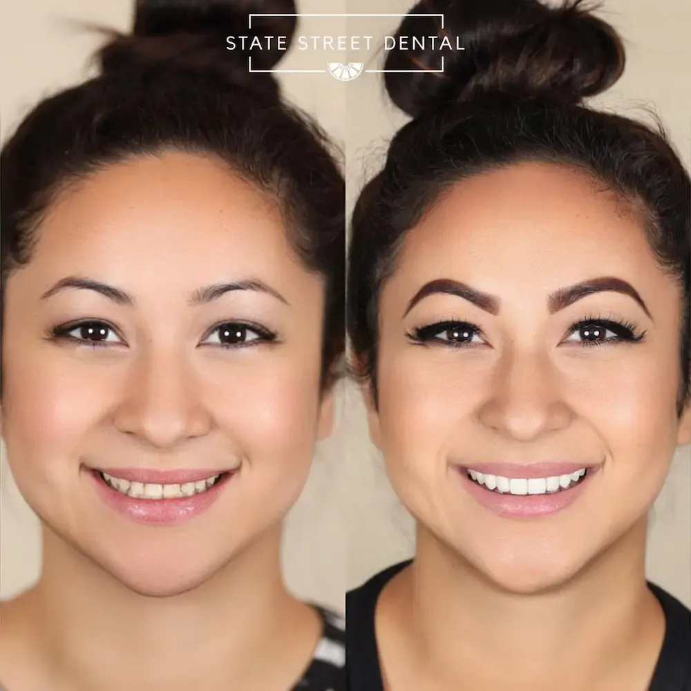 A State Street Dental veneers patient showing off their new smile