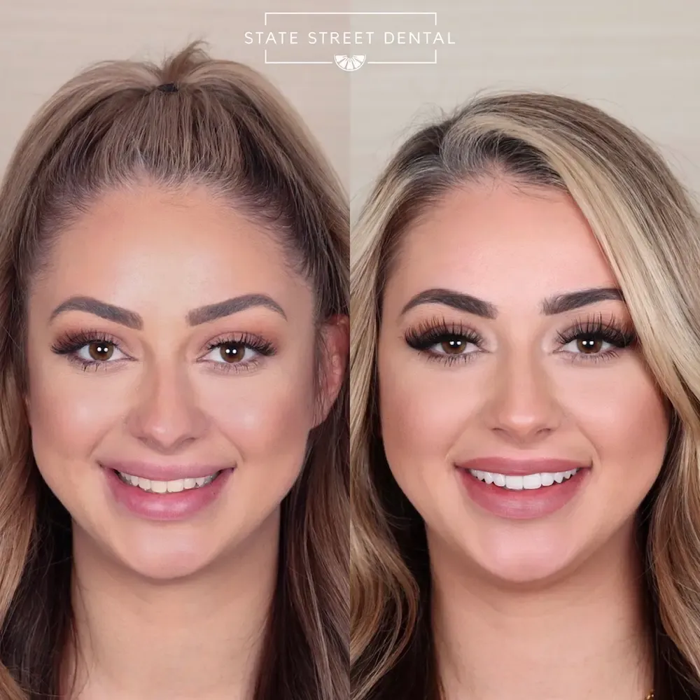 A State Street Dental veneers patient showing off their new smile