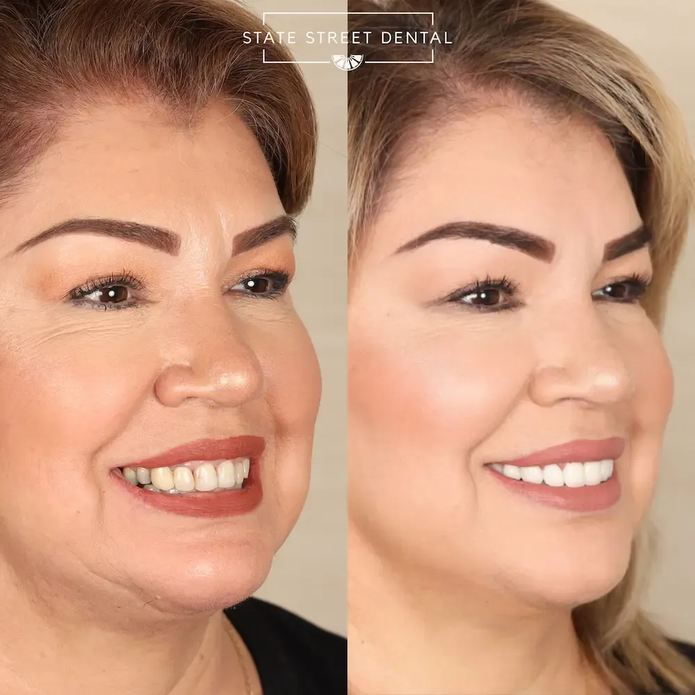 A State Street Dental veneers patient showing off their new smile