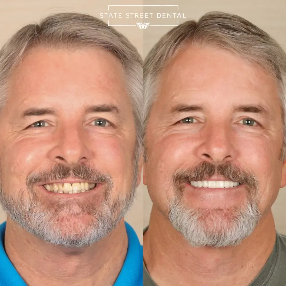 A State Street Dental veneers patient showing off their new smile