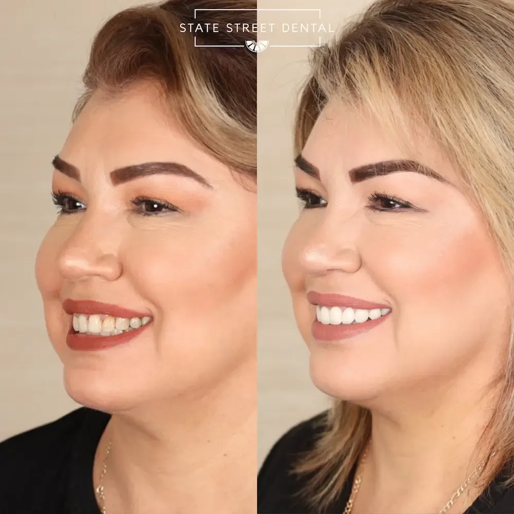 A State Street Dental veneers patient showing off their new smile