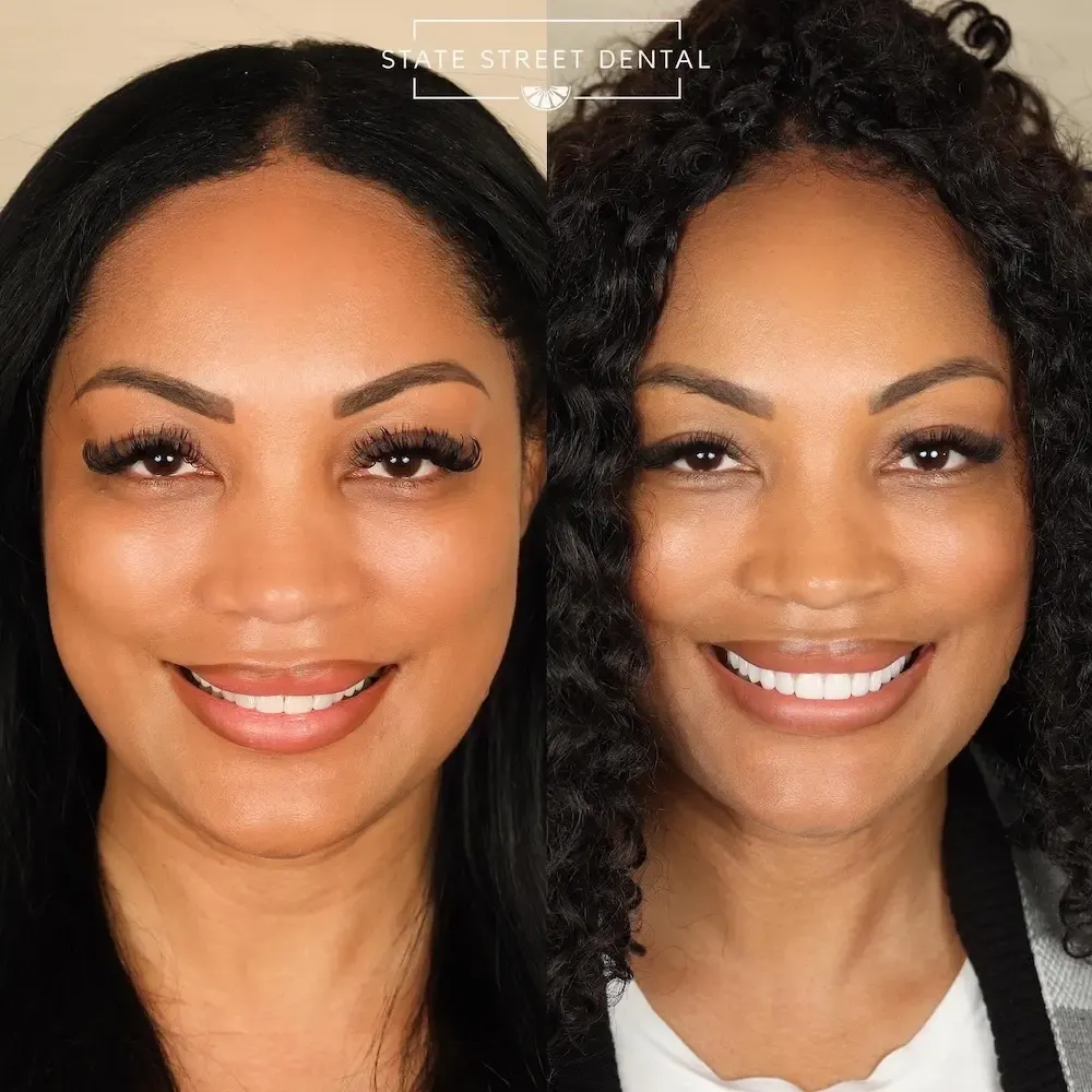 A State Street Dental veneers patient showing off their new smile