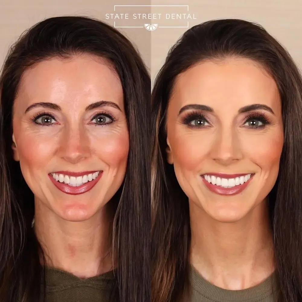 A State Street Dental veneers patient showing off their new smile