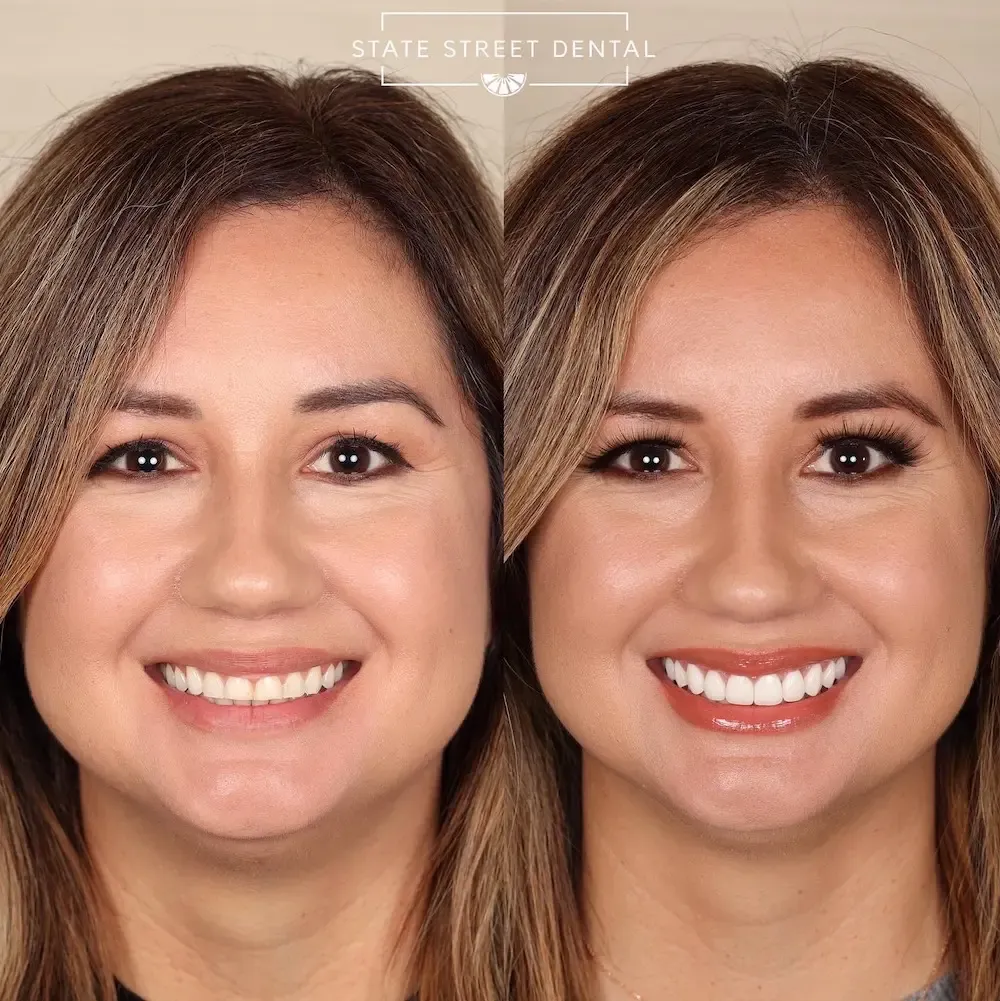 A State Street Dental veneers patient showing off their new smile